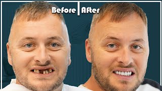 Simon from UK did dental implants in Turkey and got an AMAZING RESULT [upl. by Sawyere]