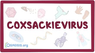 Coxsackievirus  an Osmosis Preview [upl. by Gurolinick]