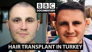 Hair Transplant Turkey  BBC Documentary  Paul Before amp After [upl. by Hun799]