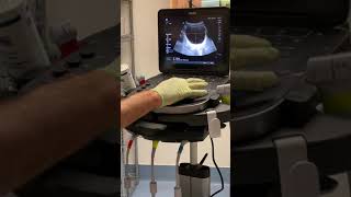 Bladder Scan Procedure [upl. by Frendel]