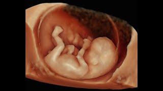 How to Perform 3D Scan of the Baby at 12 Weeks of Pregnancy [upl. by Nesnej]