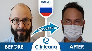 Alexeys Hair Transplant Journey in Istanbul Turkey  Clinicana reviews [upl. by Galitea]