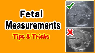 Fetal Measurements Tips and Tricks [upl. by Neelyt809]