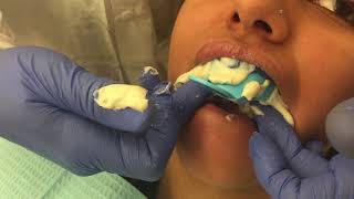 Tips for Better Alginate Impressions [upl. by Princess]