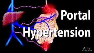 Portal Hypertension Animation [upl. by Felisha]