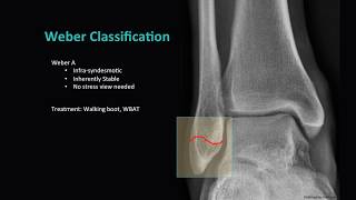 Distal Fibula Fractures [upl. by Ezeerb]