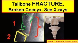 Xrays showing COCCYX FRACTURE broken tailbone [upl. by Conal]