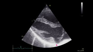 Mitral Annular Disjunction in Marfan Syndrome [upl. by Fusco]