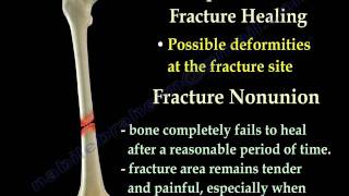 Fracture Healing Part 1  Everything You Need To Know  Dr Nabil Ebraheim [upl. by Allegra958]