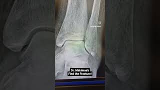 Find the fracture  distal fibula fracture [upl. by Gujral]