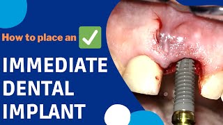 How is an IMMEDIATE DENTAL IMPLANT surgery done implants [upl. by Ariadne]