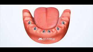 Dental Implants  Allon6 [upl. by Adekahs]