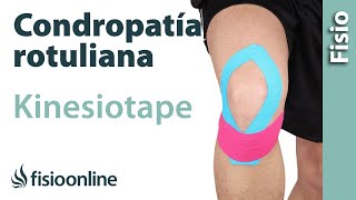 Kinesiotape para la condropatia o condromalacia rotuliana [upl. by Nnaeinahpets244]