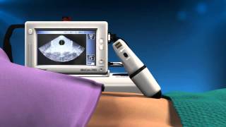 Cubescan BioCon700 Bladder Scanner  Reduce Urinary Tract Infections UTI [upl. by Nomae481]