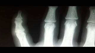 Finger Fracture Xray Findings Treatment [upl. by Eltrym177]