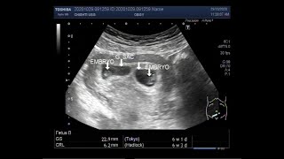 Ultrasound Video showing Early first trimester  6 weeks 01 day  twin Pregnancy [upl. by Abigael]