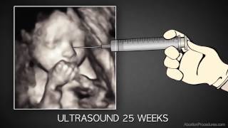 3rd Trimester Abortion [upl. by Rockwood]