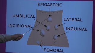 BRAIN HERNIATIONS 34  Uncal herniation [upl. by Ranita]