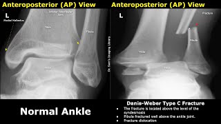 DanisWeber Classification of Ankle Fractures XRay Normal Vs Abnormal Images  Fibular Fractures [upl. by Hoppe]