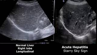 ASCITES  causespathophysiology dx and treatment by DoctScape [upl. by Ardnot]