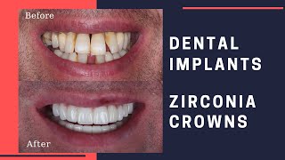 Dental Implants amp Zirconia Crowns Patient Review [upl. by Alecia]