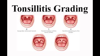 Tonsillitis Grading [upl. by Imyaj]