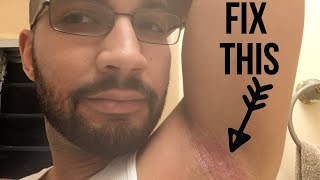 Fix ArmpitHeat Rash From Home [upl. by Gayner]