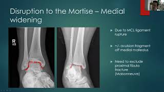 Ankle fracture xray interpretation [upl. by Drolyag]